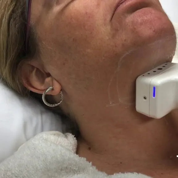 truSculpt iD- Initial Evaluation (Double Chin)