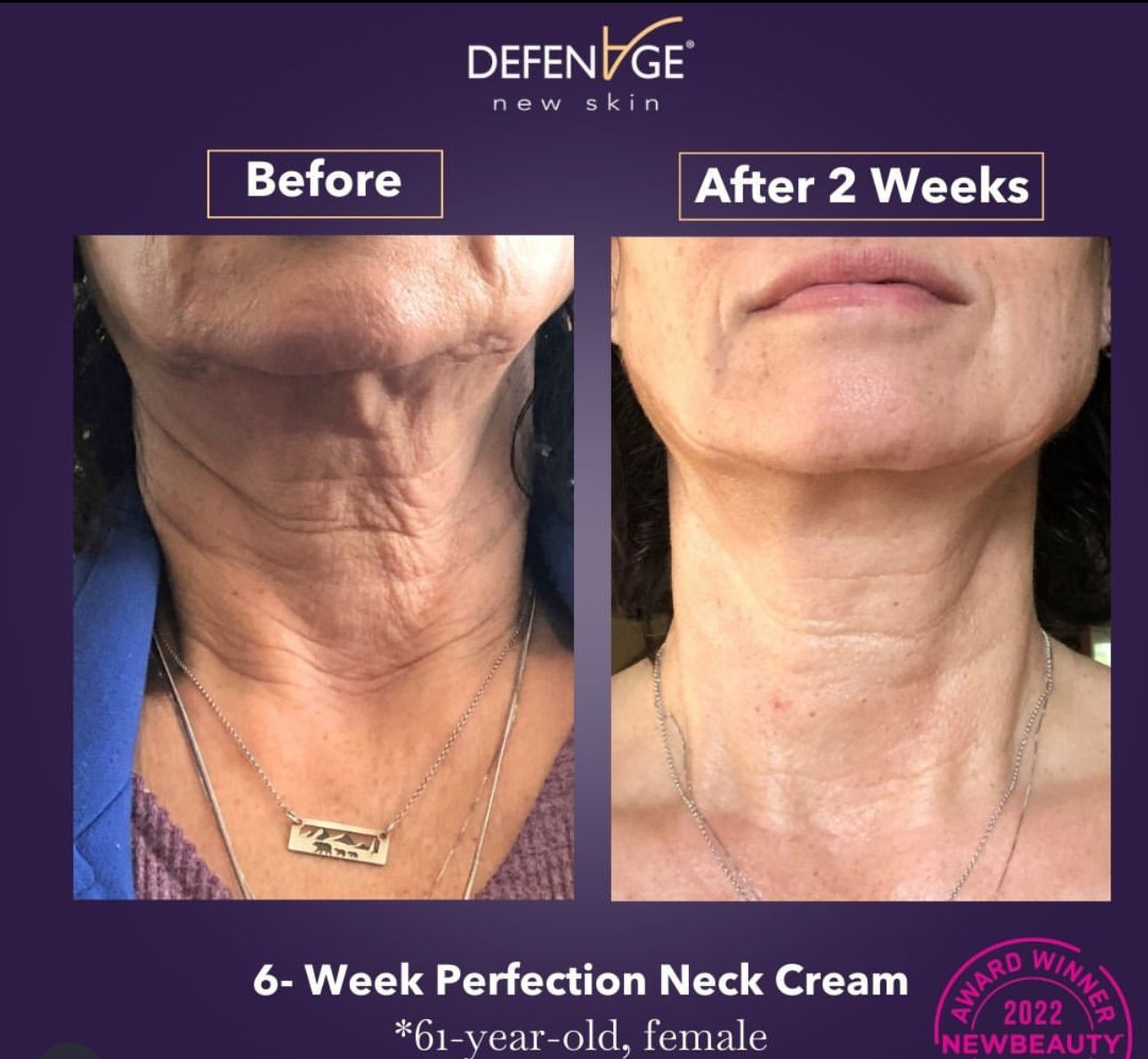 Before and after comparison of neck skin with Defenage neck cream, showing reduced wrinkles.