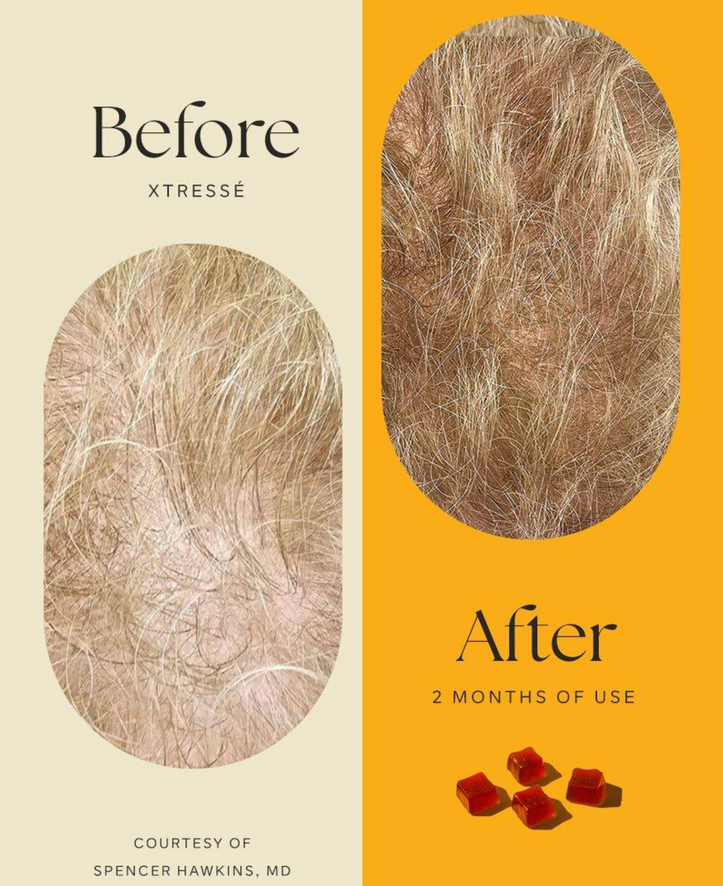 Xtressé™ ( 1 MONTH SUPPLY) image 1