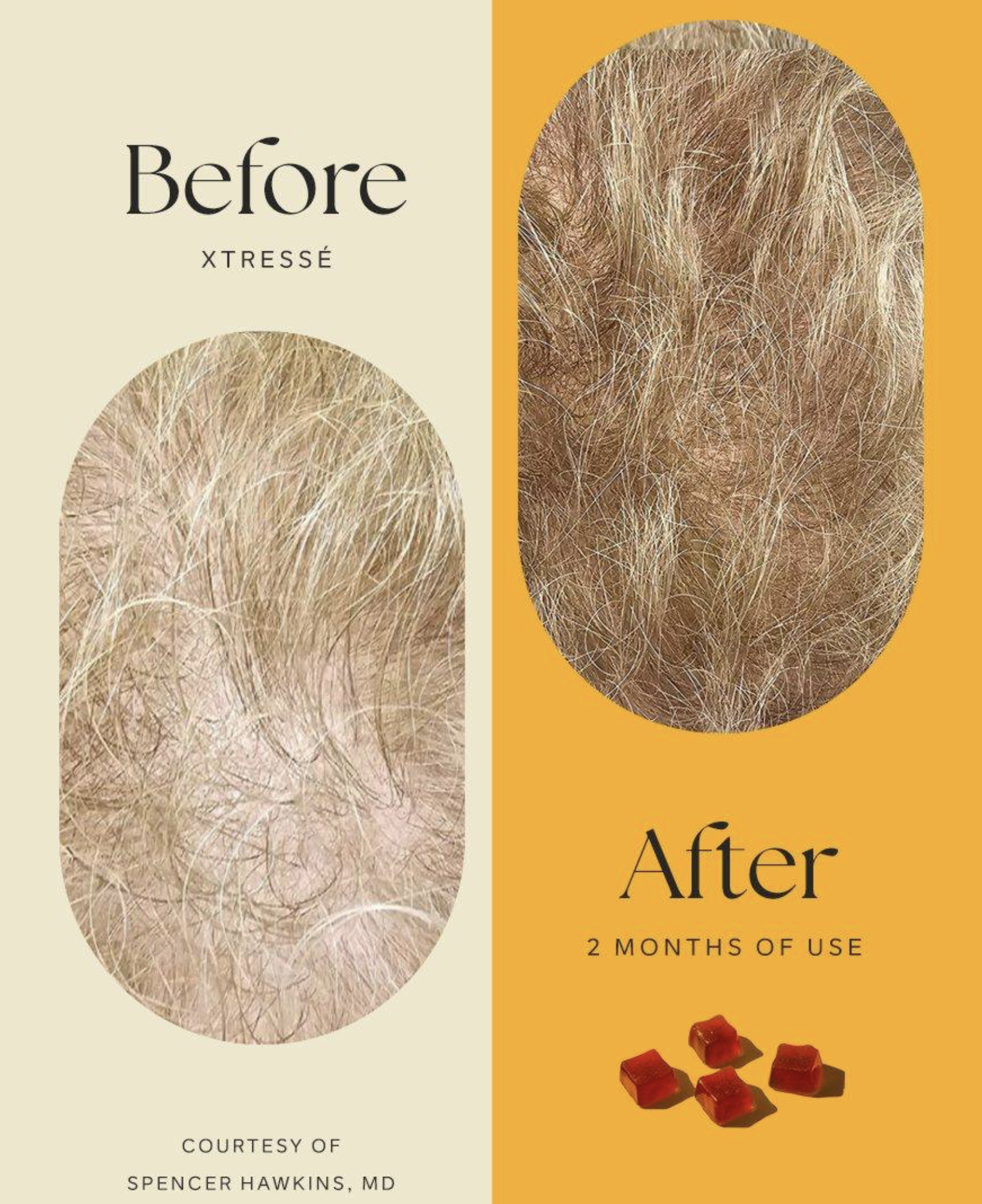Xtressé™ ( 1 MONTH SUPPLY) image 1
