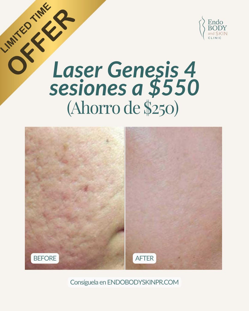 ✨Laser Genesis (Hollywood Facial) - 4 Treatments✨