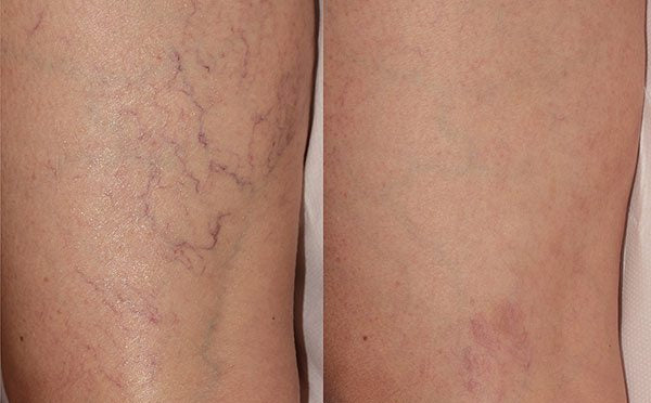 Comparison of varicose veins on a person's leg before and after treatment.