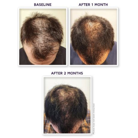 DefenAge® 150K HAIR FOLLICLE SERUM
 (1-month-supply Refill)