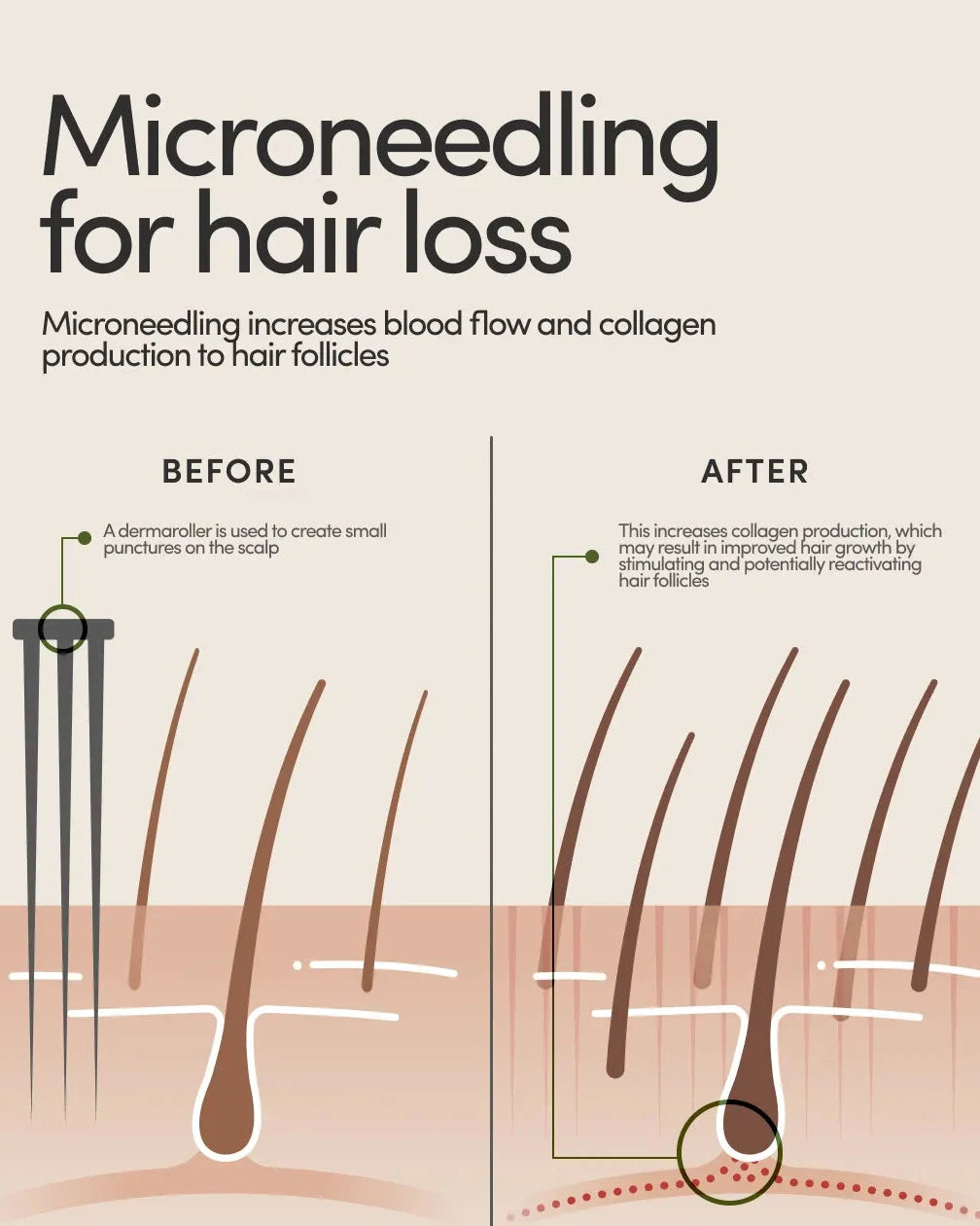 Microneedling with Exosomes for HAIR LOSS