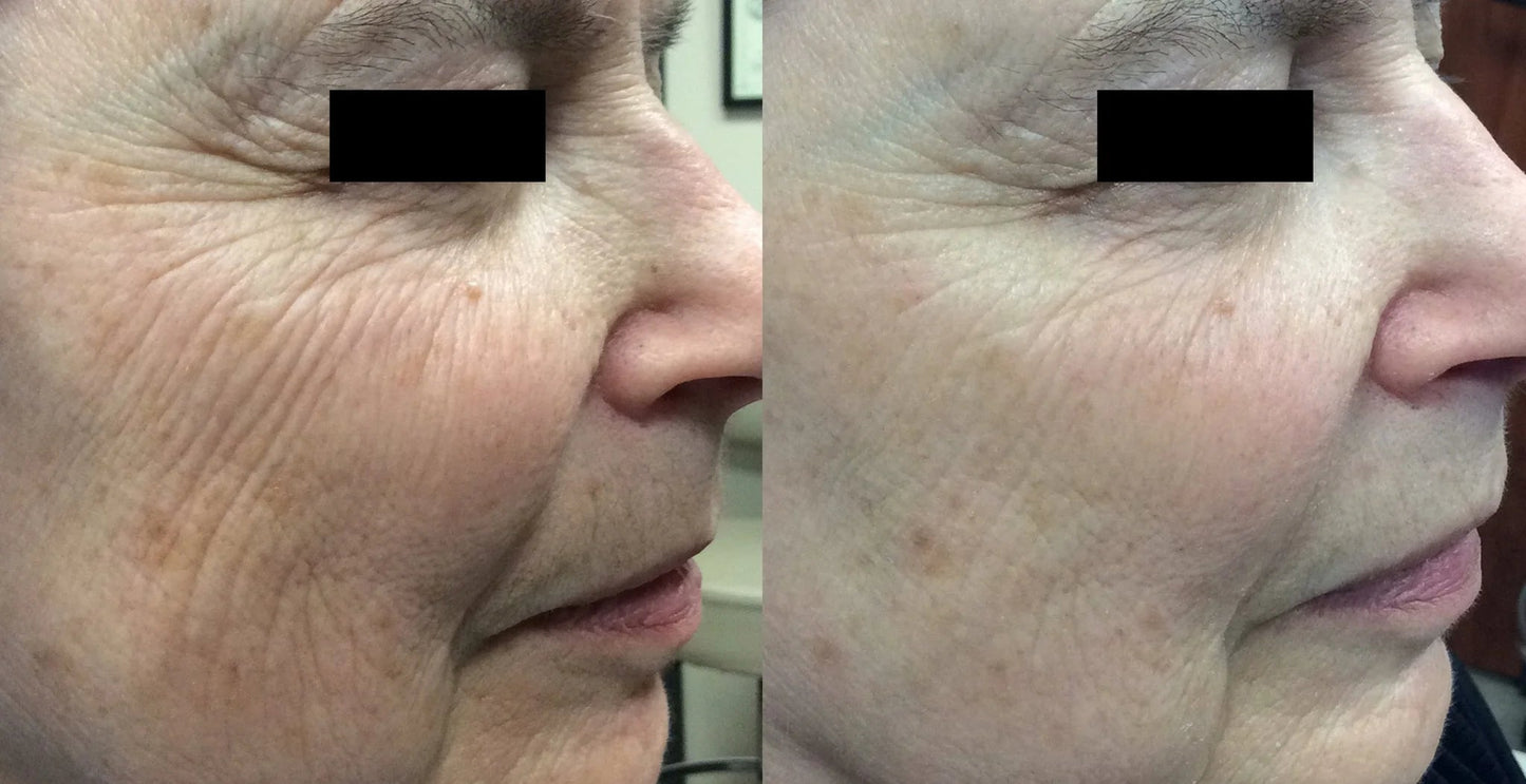 Laser Genesis (non-ablative)- Initial Evaluation