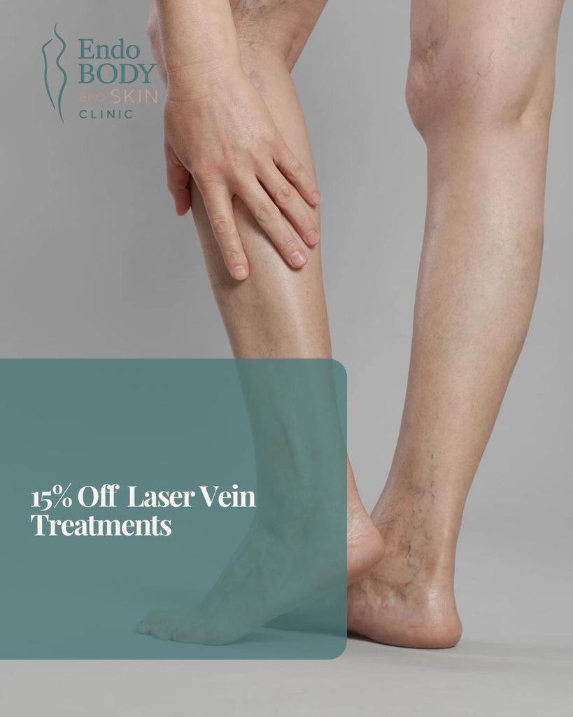 15% OFF: Laser Vein Treatments