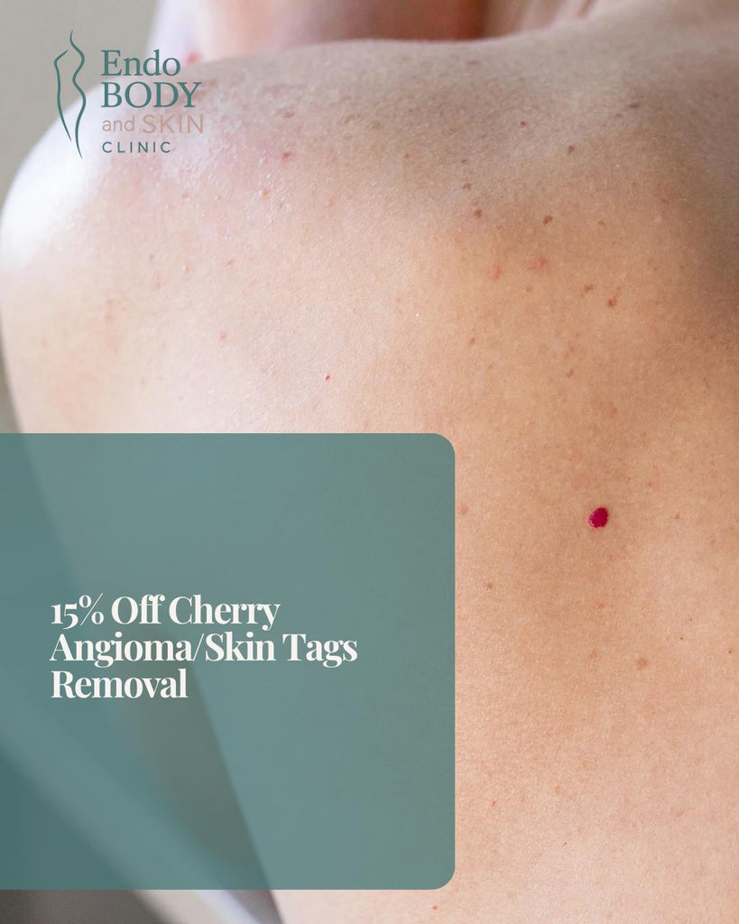 15% OFF: Skin Tags/Cherry Angioma Removal