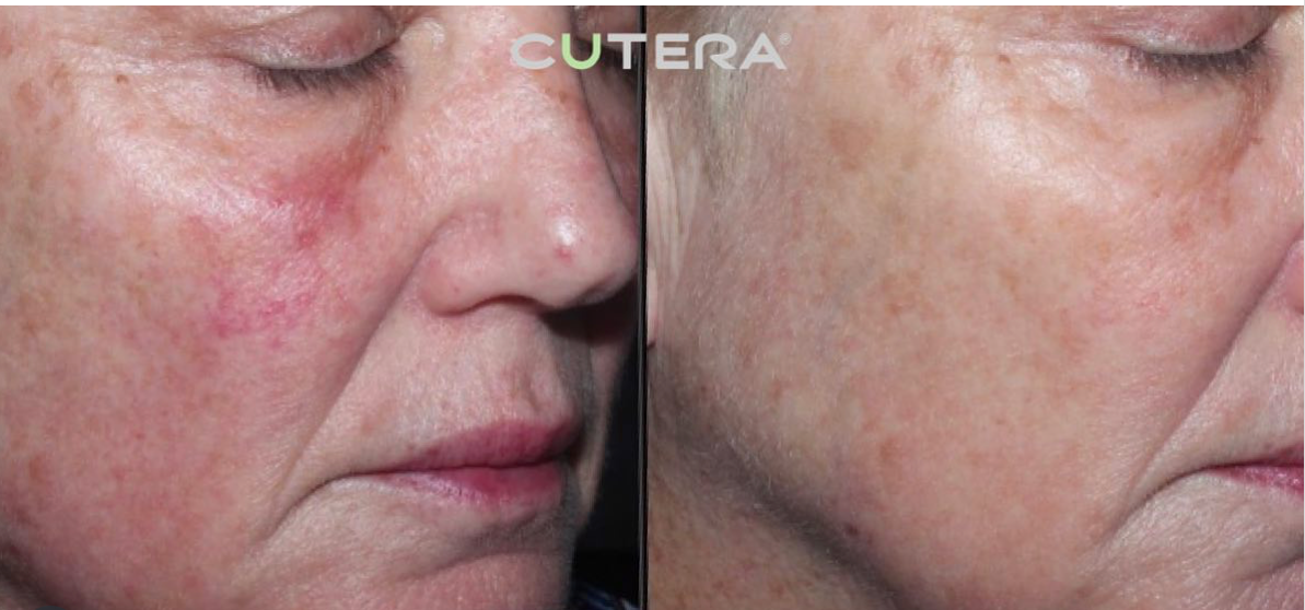 Laser Genesis (non-ablative)- Initial Evaluation