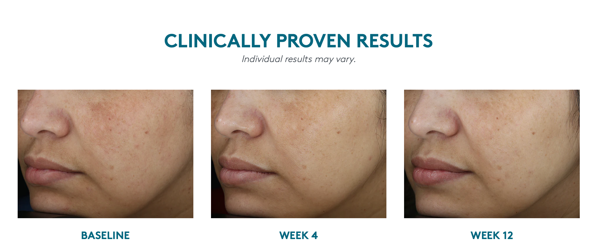 Even Up® Clinical Pigment Perfector® SPF 50(Manchas)