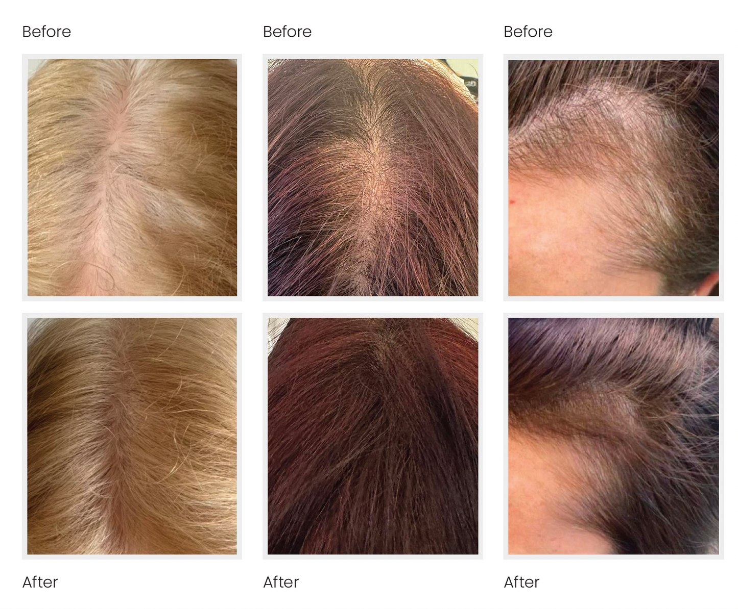 Microneedling with Exosomes for HAIR LOSS