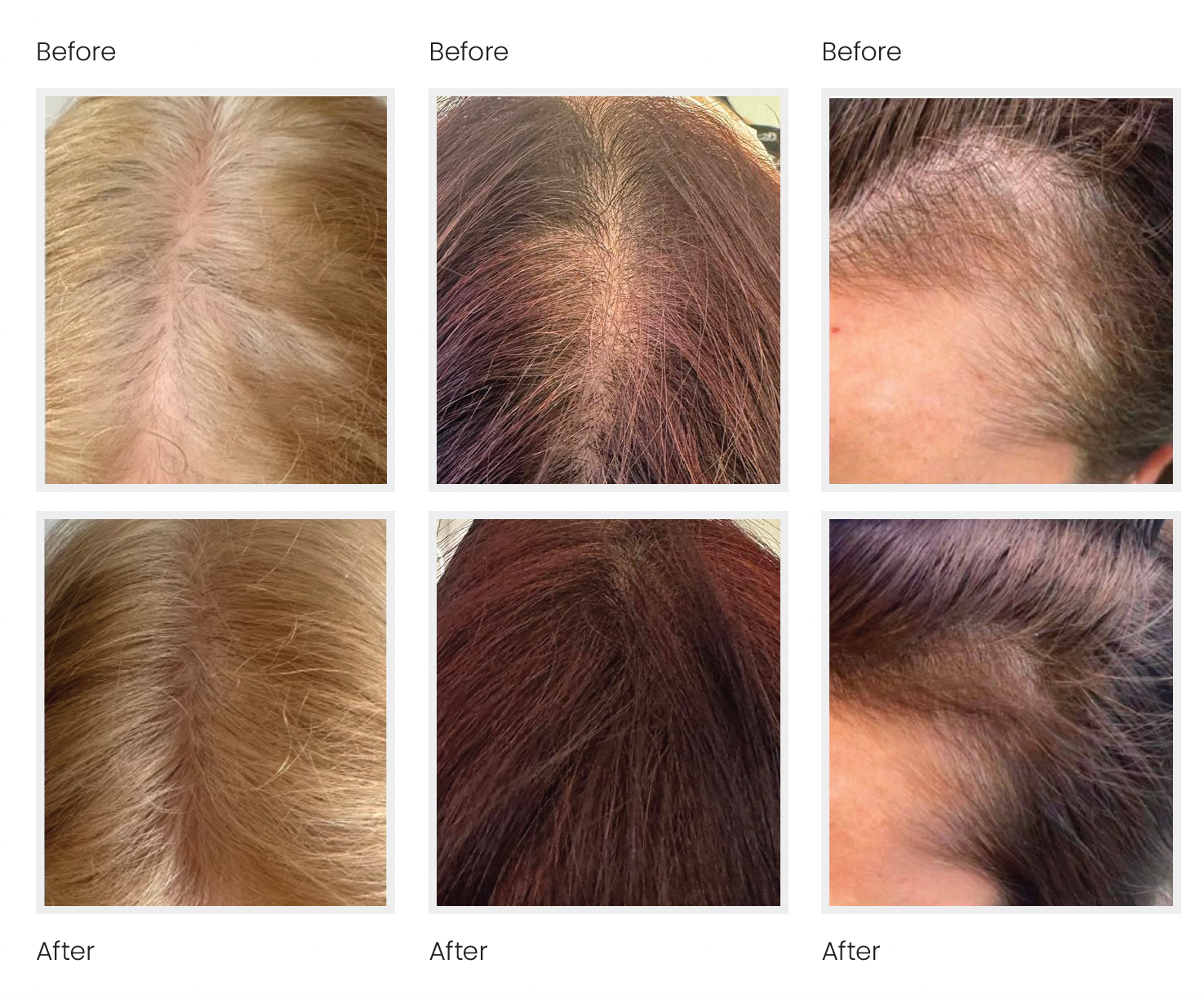 Microneedling for Hair with Hair Exosomes