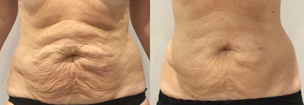 TruSculpt iD + Flex  Initial Evaluation