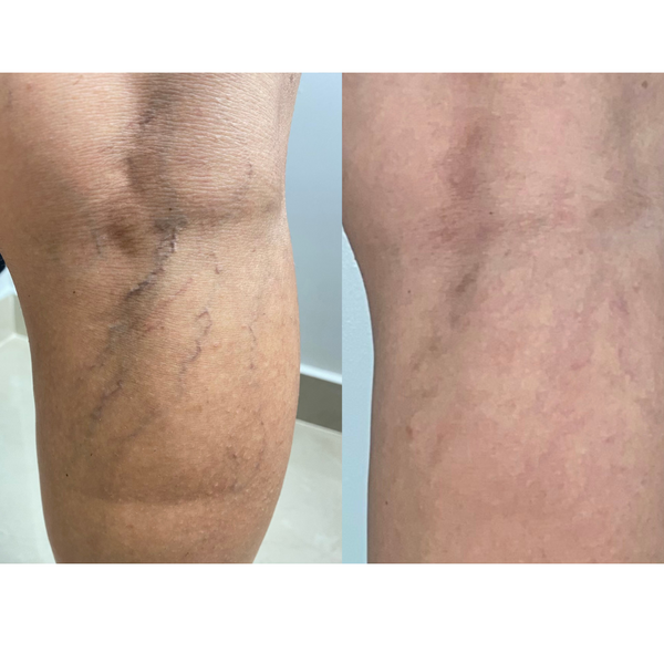 15% OFF: Laser Vein Treatments