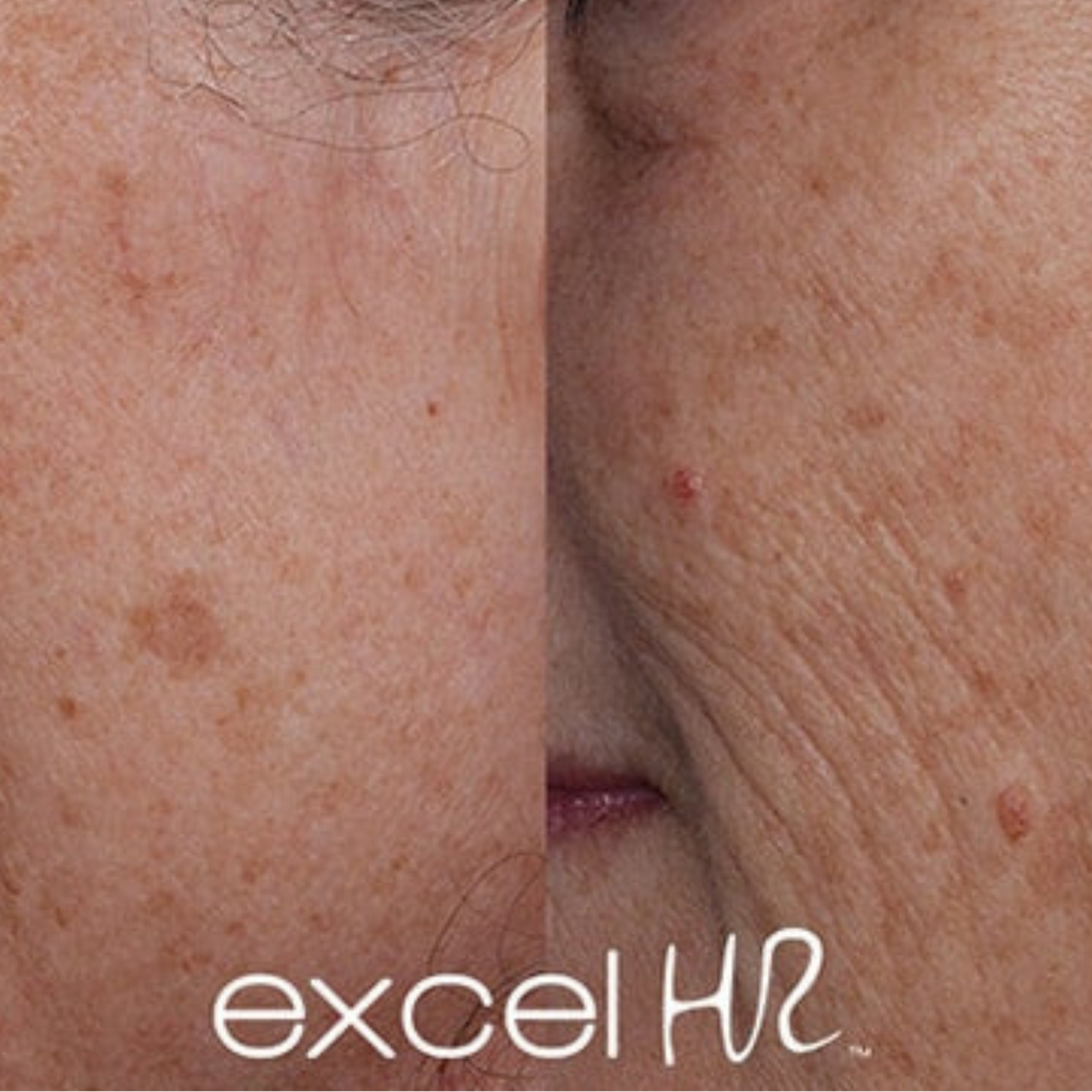 Skin Tags/Cherry Angioma/Solar lentigo Treatment