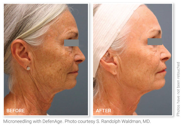Before and after comparison of microneedling treatment on an elderly woman's face.