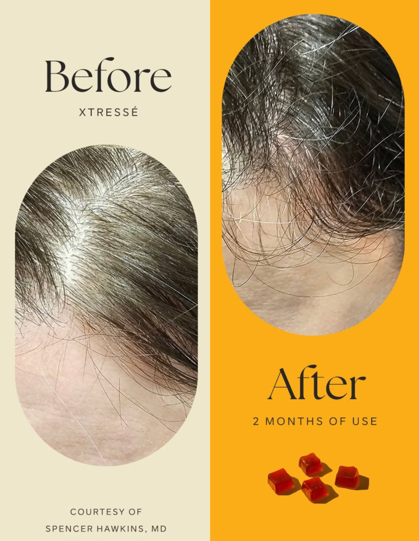 Xtressé™ ( 1 MONTH SUPPLY) image 2