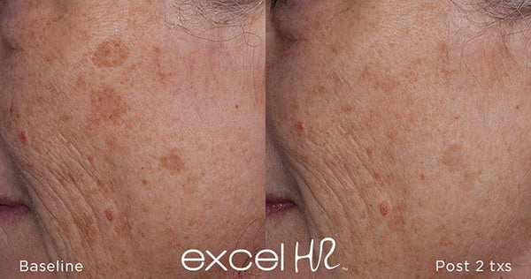 Before and after comparison of skin treatment with 'excel HR' branding.