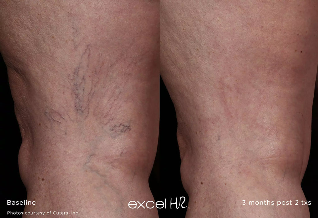 Before and after comparison of varicose veins on a person's legs, labeled 'Baseline' and '3 months post 2 txs'.