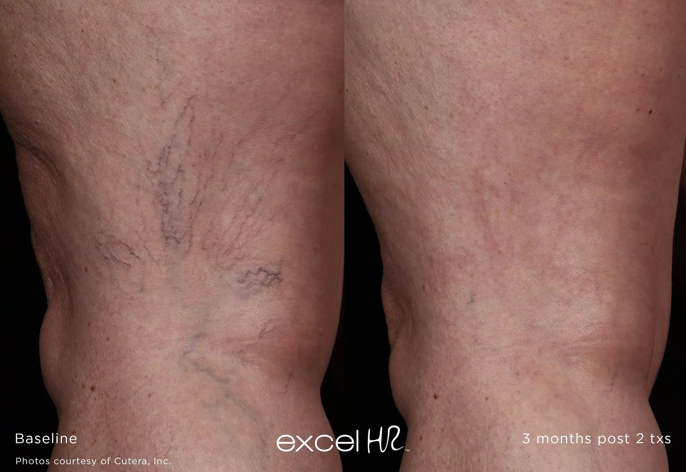 Before and after comparison of varicose veins on a person's legs, labeled 'Baseline' and '3 months post 2 txs'.