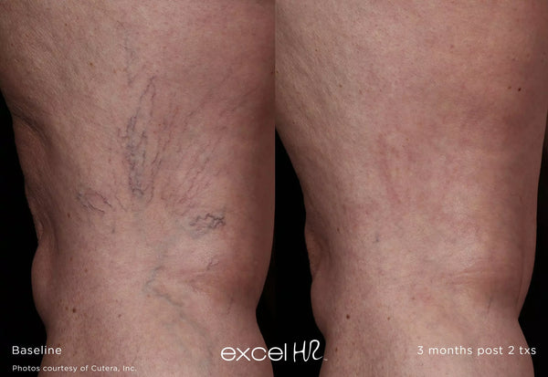 Before and after comparison of varicose veins on a person's legs, labeled 'Baseline' and '3 months post 2 txs'.