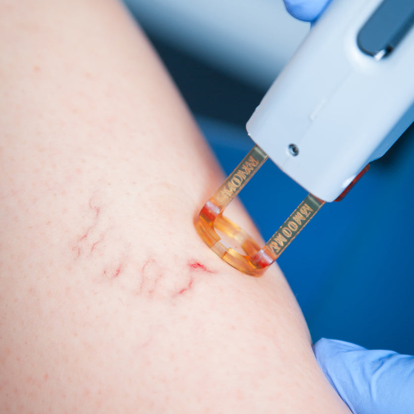 Laser Vein Treatment- Initial Evaluation
