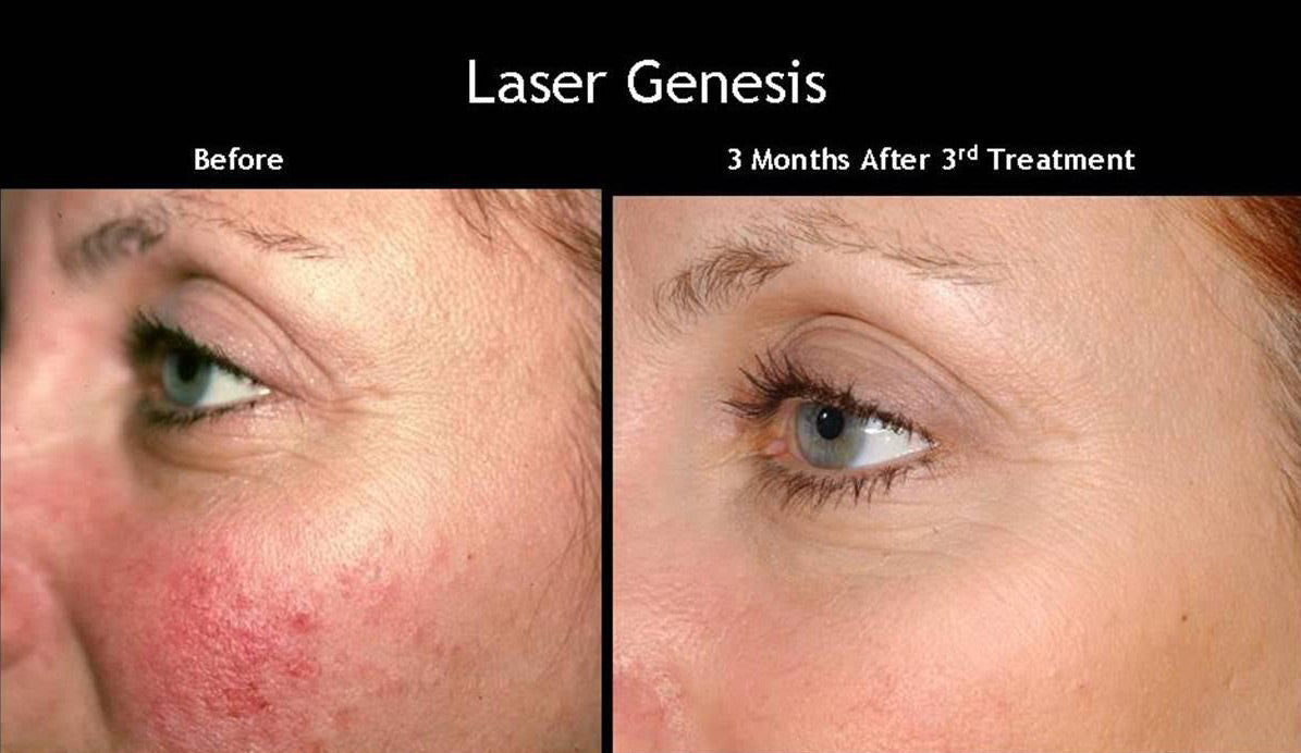 Laser Genesis (non-ablative)- Initial Evaluation