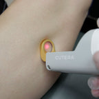 Laser Vein Treatment ✨