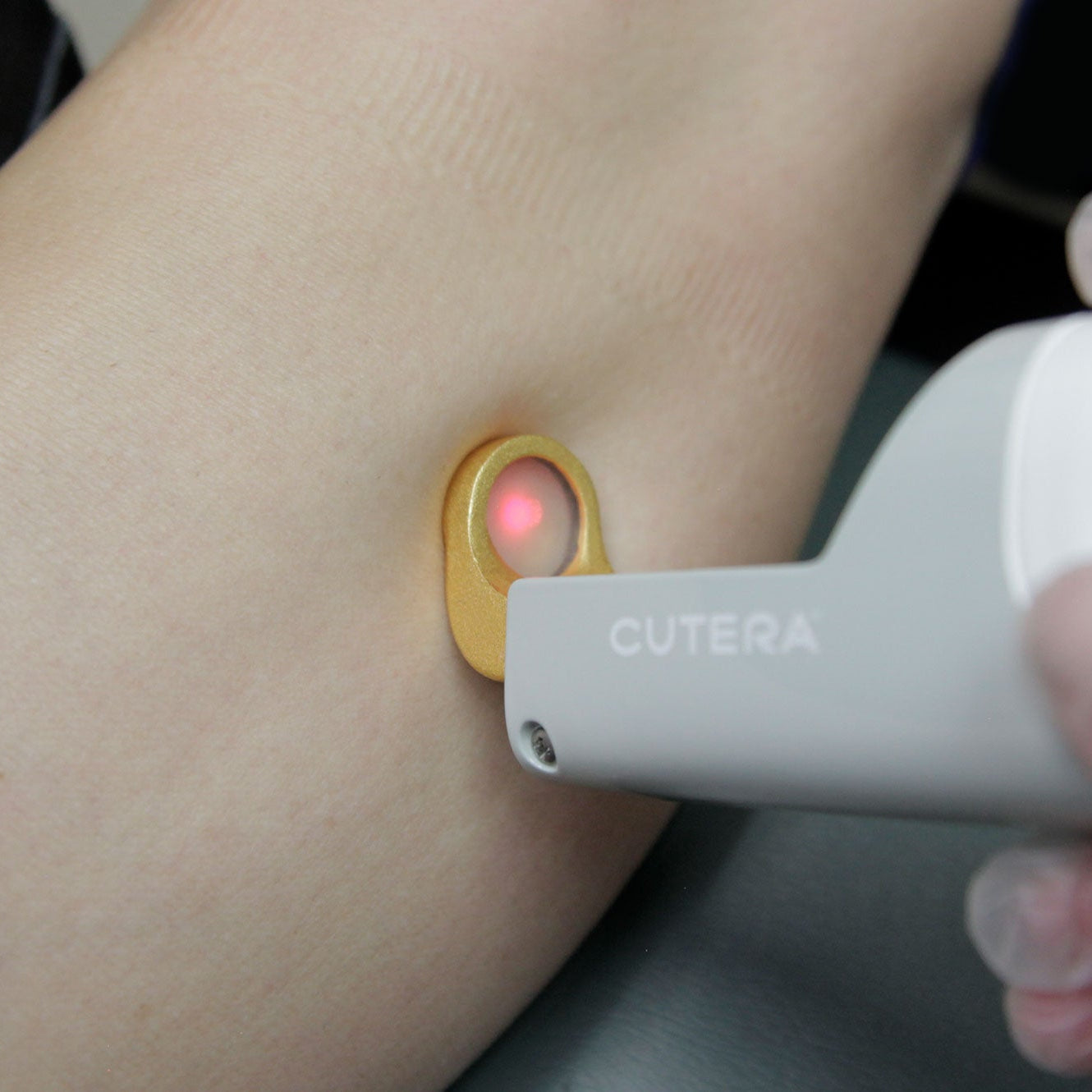 Laser Vein Treatment ✨