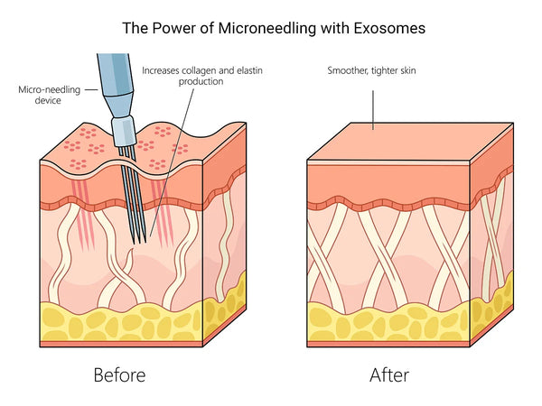 ✨July Offer: $300✨ MICRONEEDLING WITH EXOSOMES